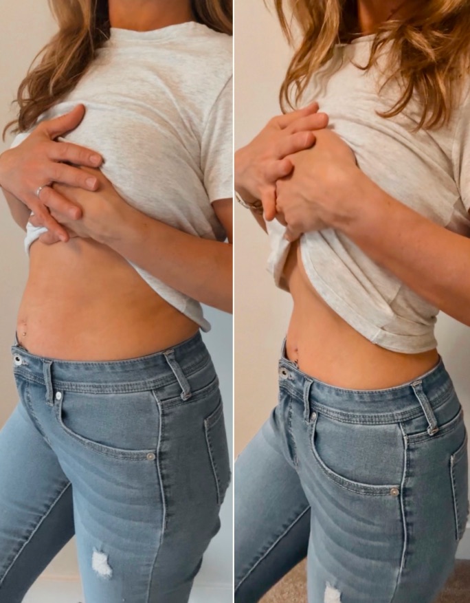The same stomach, before and after