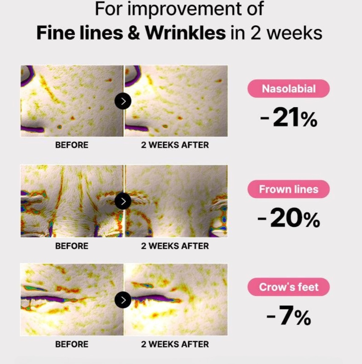 Fine lines and wrinkles, before and after 2 weeks